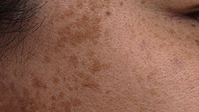 <p>Fade <strong>dark spots</strong> & even <strong>skin tone</strong></p>