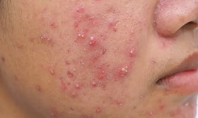 <p>Clear<strong> acne</strong> and prevent <strong>breakouts</strong></p>