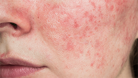 <p>Calm<strong> redness</strong> and soothe <strong>irritation</strong></p>